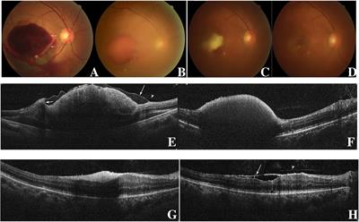 Efficiency and Complication of 577-nm Laser Membranotomy for the Treatment of Retinal Sub-Inner Limiting Membrane Hemorrhage